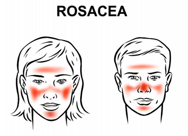 Rosacea